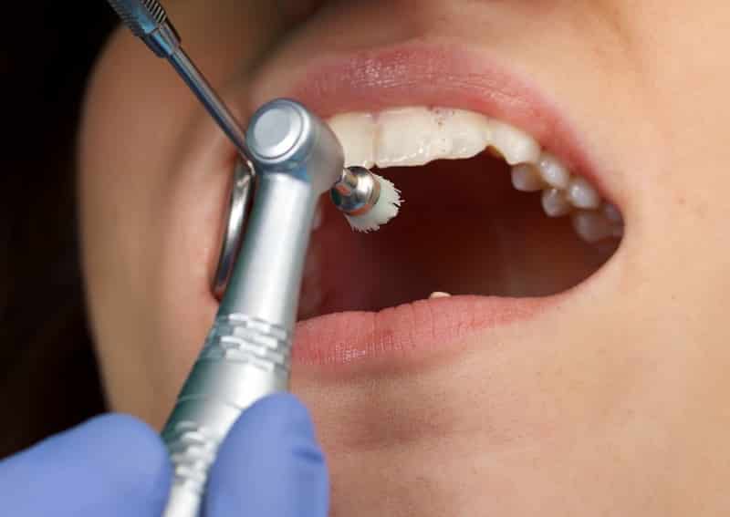 Professional Dental Cleaning